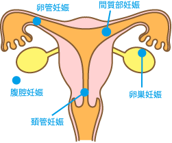 子宮外妊娠